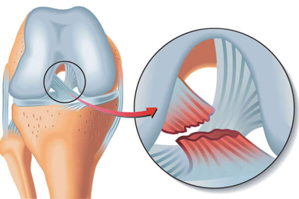Muscle & Ligament Tear Repair