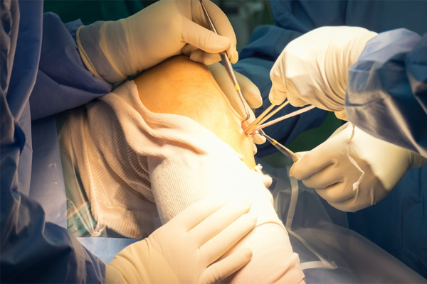 ACL Ligament Surgery Bihar