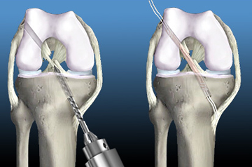 acl-ligament-in-sikar