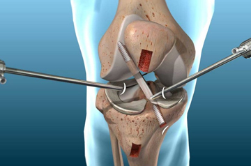 acl-surgery-doctor-in-rajasthan
