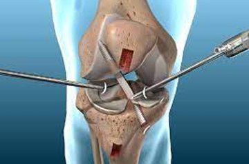 acl-tear-surgery-in-jaipur