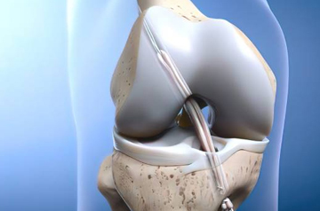 acl-tear-surgery-in-jaipur