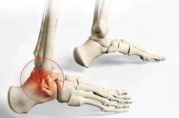 ankle-ligament-surgery-in-jaipur