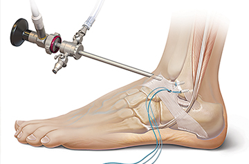 ankle-ligament-surgery-in-rajasthan