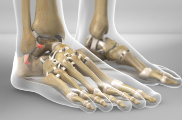 ankle-ligament-surgery-in-jaipur