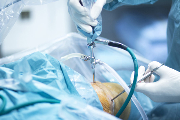 Arthroscopy Surgery In Punjab