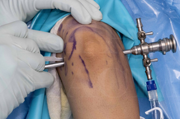 arthroscopy-surgery-in-sikar