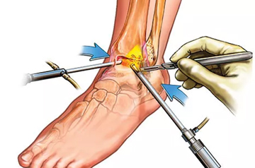 atfl-treatment-in-jaipur