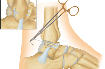 atfl-treatment-in-rajasthan
