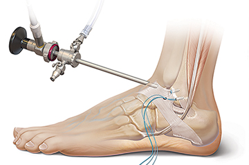 atfl-treatment-in-jaipur