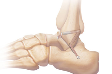 atfl-treatment-in-rajasthan
