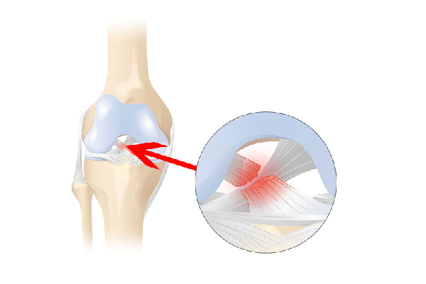 Best Knee Ligament Repair In Rajasthan
