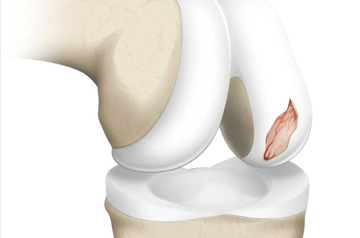 cartilage-injury-treatment-in-jaipur