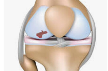 cartilage-injury-treatment-in-rajasthan