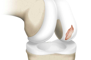 cartilage-injury-treatment-in-rajasthan