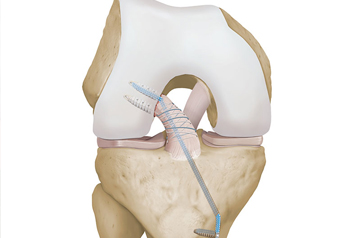 internal-brace-surgery-in-jaipur