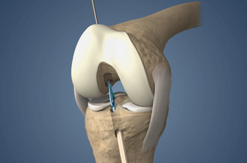 internal-brace-surgery-in-rajasthan