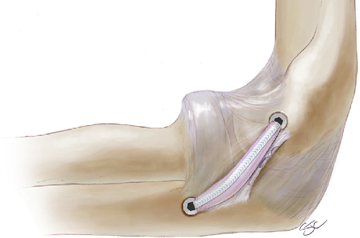 internal-brace-surgery-in-jaipur
