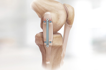 internal-brace-surgery-in-rajasthan