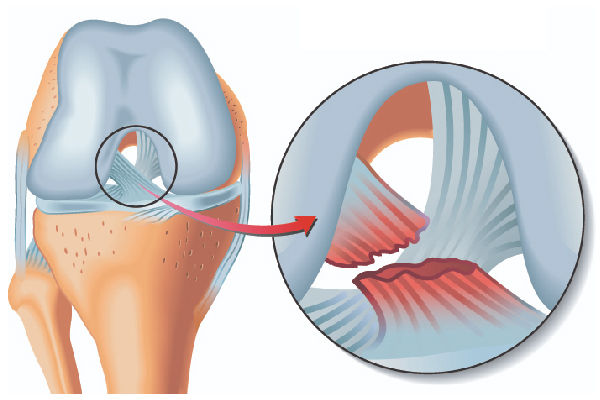 Knee Ligament Repair In Rajasthan