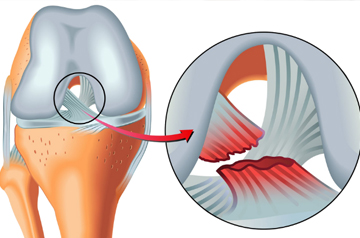 knee-ligament-repair-in-sikar