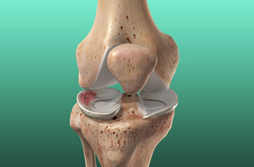 meniscus-tear-treatment-in-jaipur