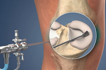 meniscus-tear-treatment-in-rajasthan