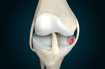 meniscus-tear-treatment-in-jaipur