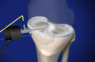 meniscus-tear-treatment-in-rajasthan