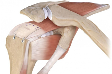 rotator-cuff-tear-surgery-in-rajasthan