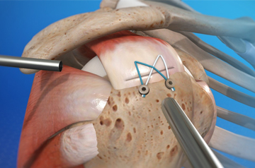rotator-cuff-treatment-in-sikar