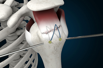 rotator-cuff-treatment-in-sikar