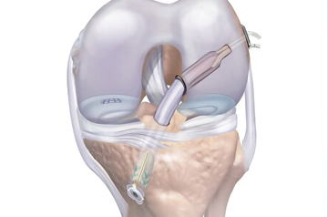acl-doctor-in-sikar