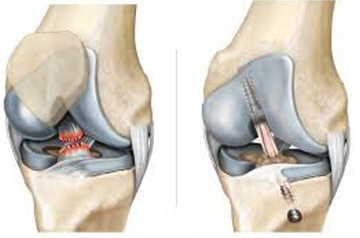 acl-tear-surgery-in-ajmer