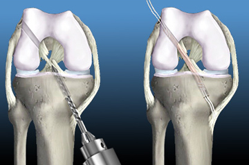 acl-tear-surgery-in-sikar