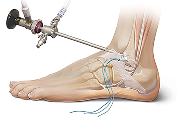 ankle-ligament-surgery-ajmer