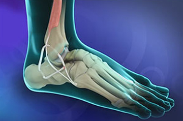 ankle-ligament-surgery-ajmer