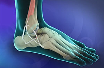 ankle-ligament-surgery-in-sikar