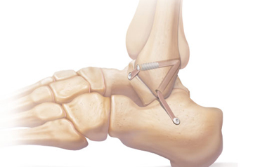 atfl-treatment-in-sikar