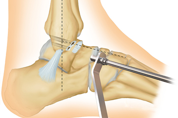 atfl-treatment-in-sikar