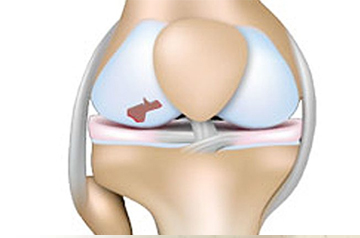 cartilage-injury-treatment-in-ajmer