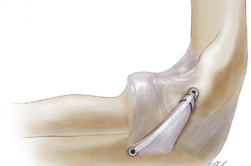 internal-brace-surgery-in-ajmer