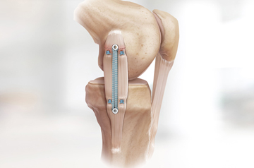 internal-brace-surgery-in-ajmer