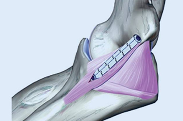 internal-brace-surgery-in-sikar