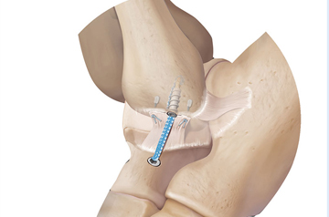 internal-brace-surgery-in-sikar