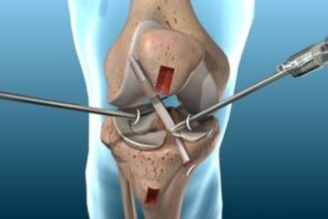 ACL Ligament Surgeries in Arab