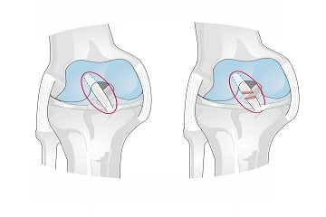 ACL Ligament Surgery Bangladesh