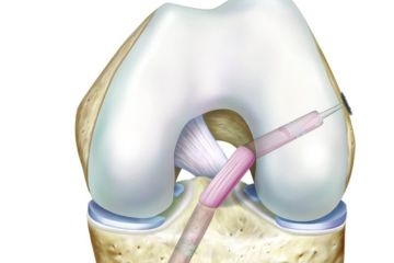 ACL Ligament Surgery in Arab