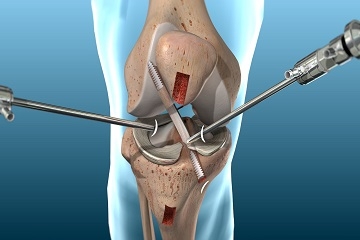 ACL Ligament Surgery In Jamshedpur