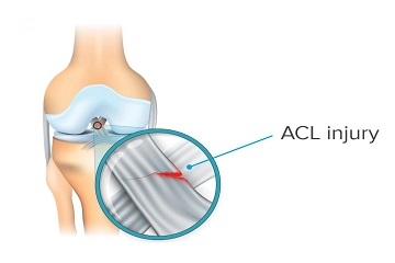 ACL Ligament Surgery Kenya